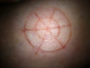 Étranges traces circulaires cutanées